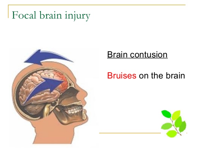 A contusion on the brain