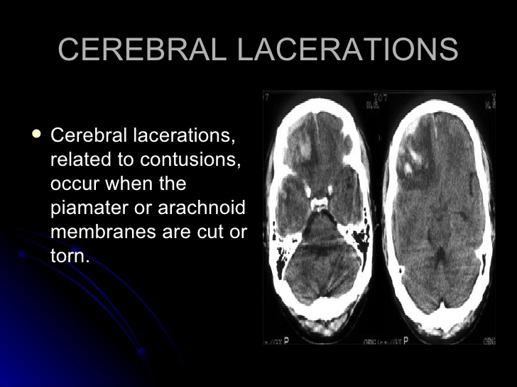 Laceration of brain