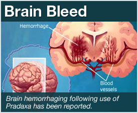 brain-hemorrhaging