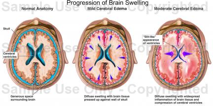 brain swelling pictures